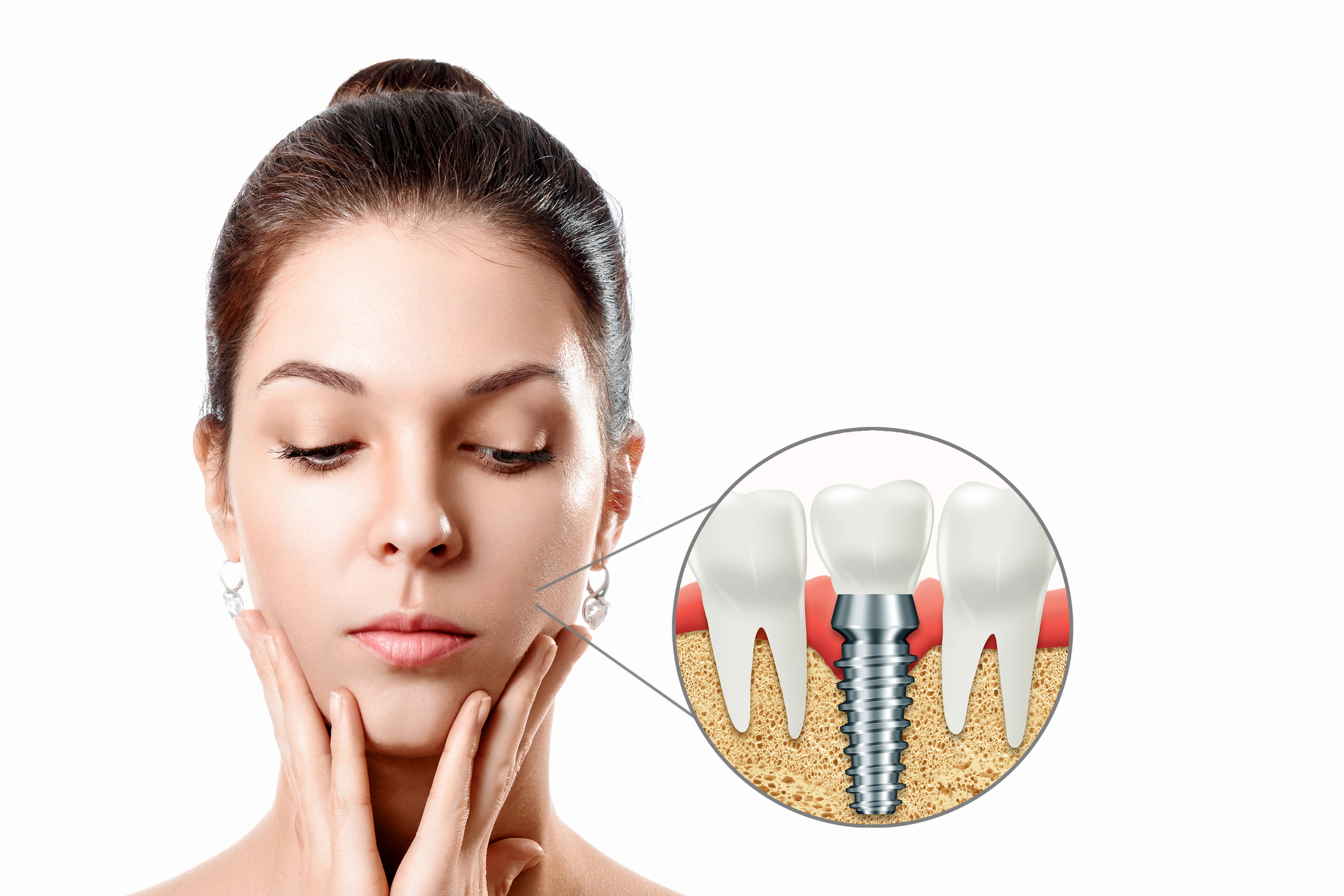 infecție după implant dentar