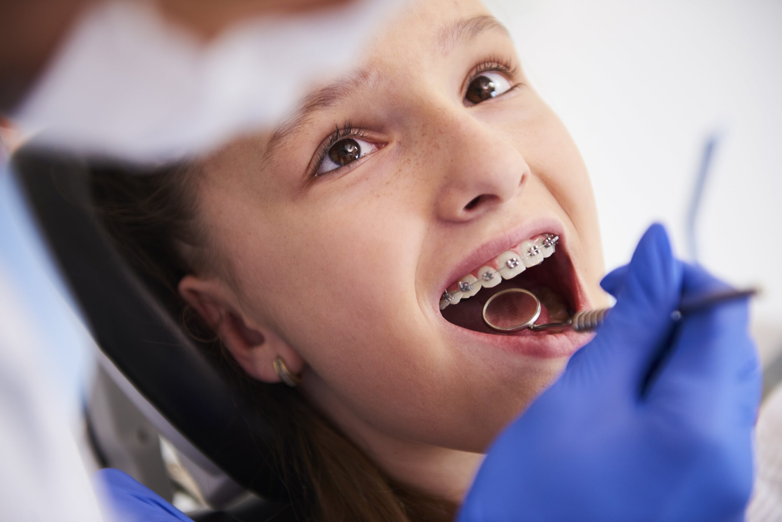 Aparat dentar pentru copii: când este momentul potrivit și ce trebuie să știi