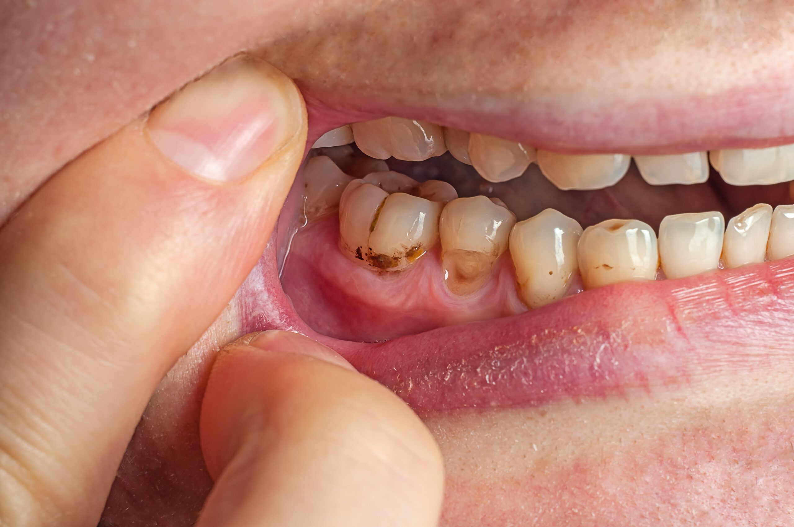plombă dentară cu anestezie