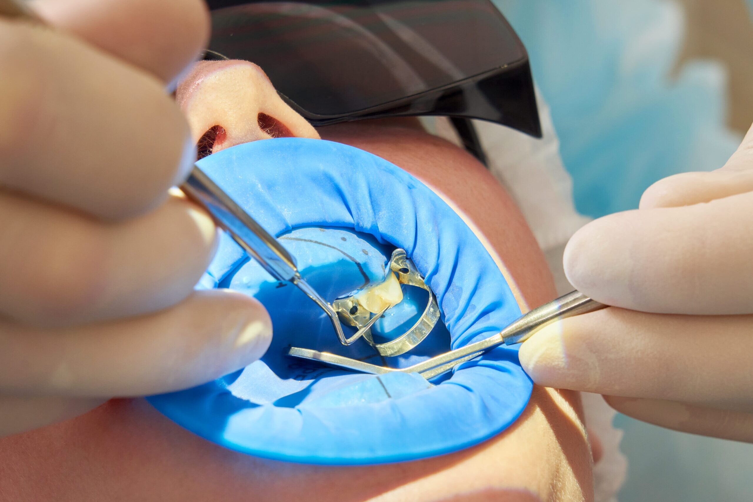 plombă dentară