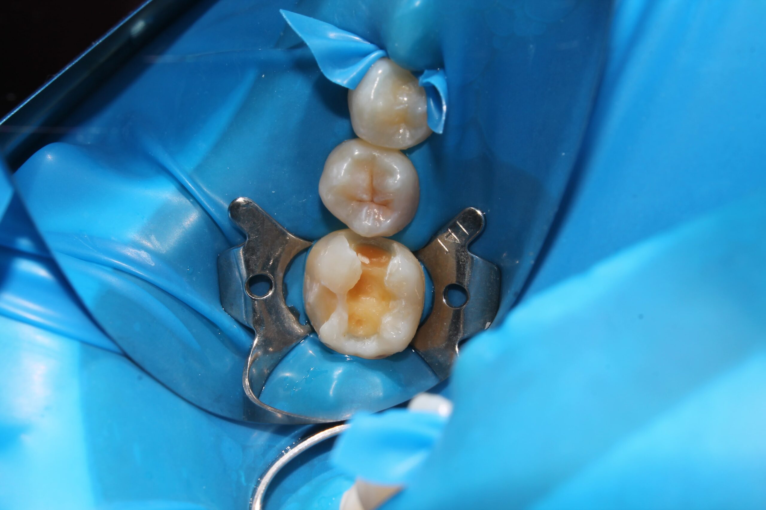 cât durează o plombă dentară
