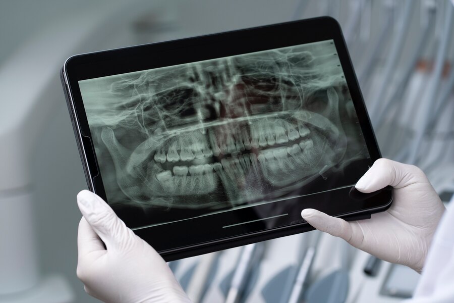 Interpretarea radiografiei dentare explicată