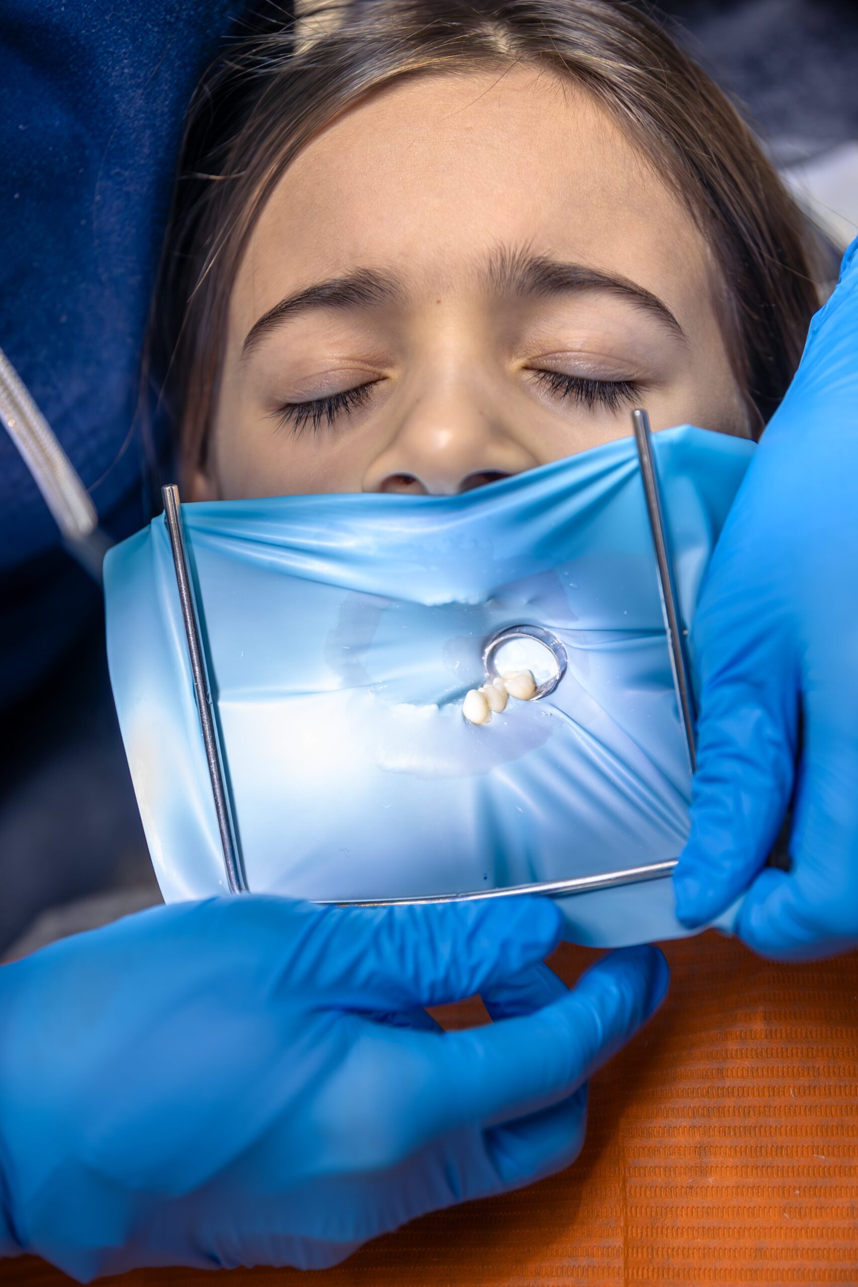 Diga dentară: Protecția invizibilă care face diferența în tratamentele stomatologice