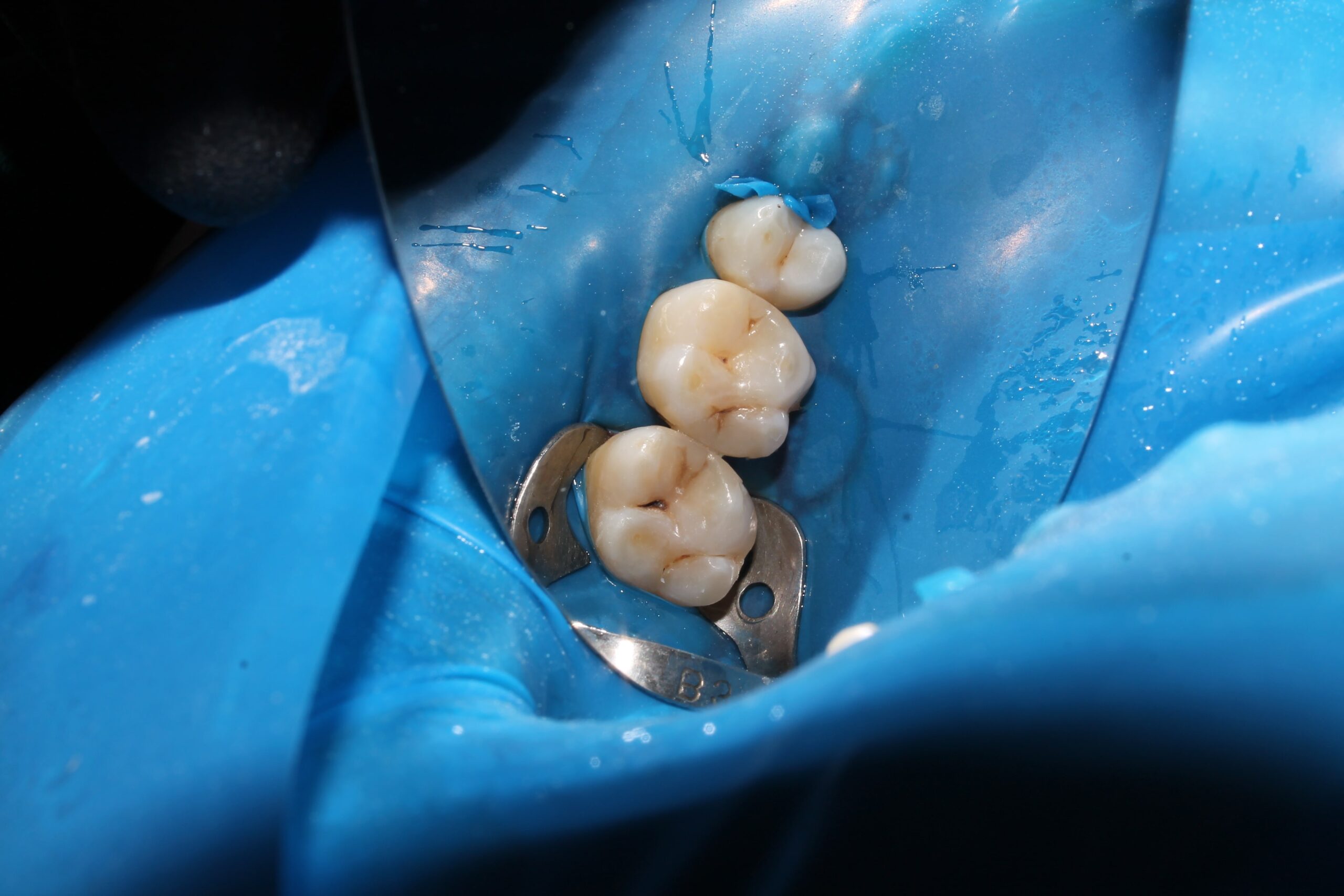 Cum te ajută diga în tratamentele dentare moderne?