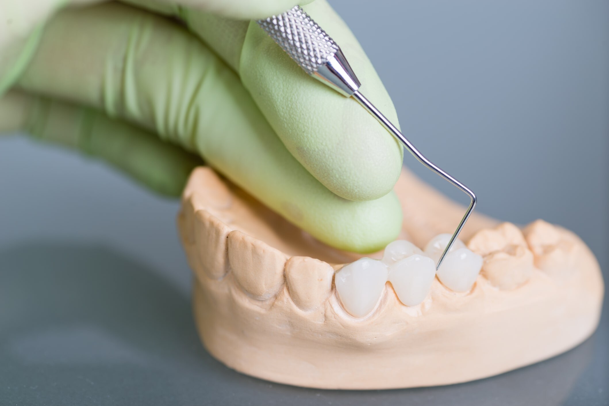 7 semne că puntea dentară trebuie schimbată