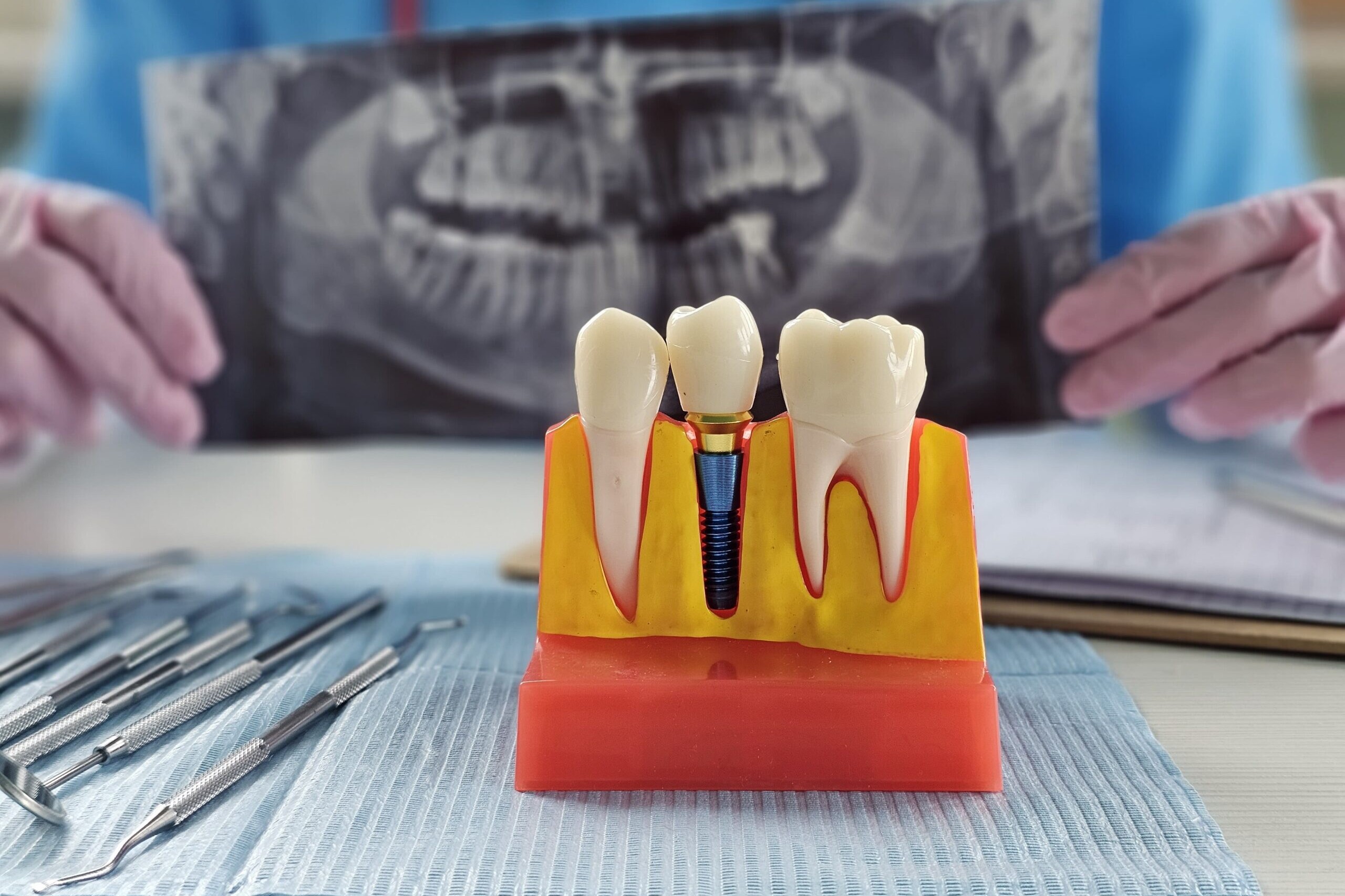 De ce nu trebuie să amâni un implant dentar – Riscuri, costuri și efecte pe termen lung