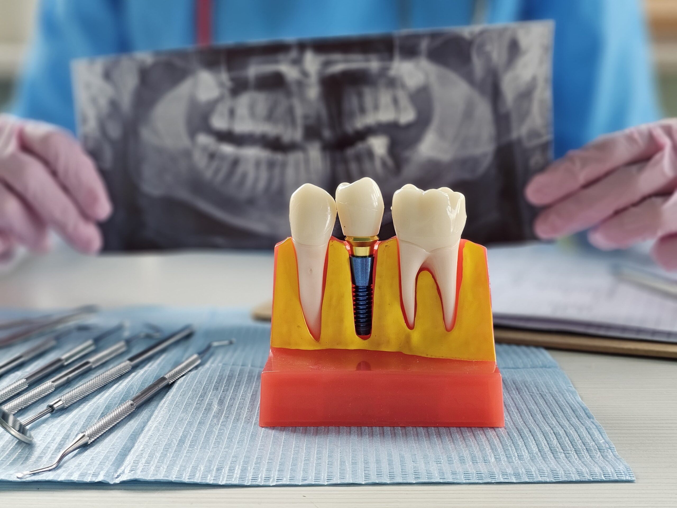 De ce nu trebuie să amâni un implant dentar – Riscuri, costuri și efecte pe termen lung