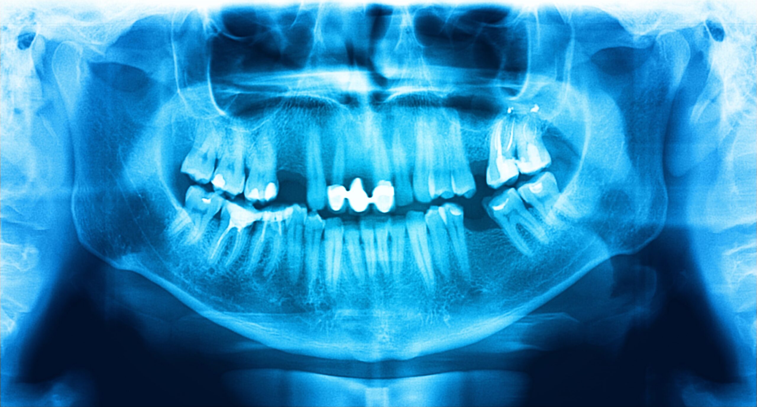 Cum afectează migrarea dentară sănătatea ta orală?